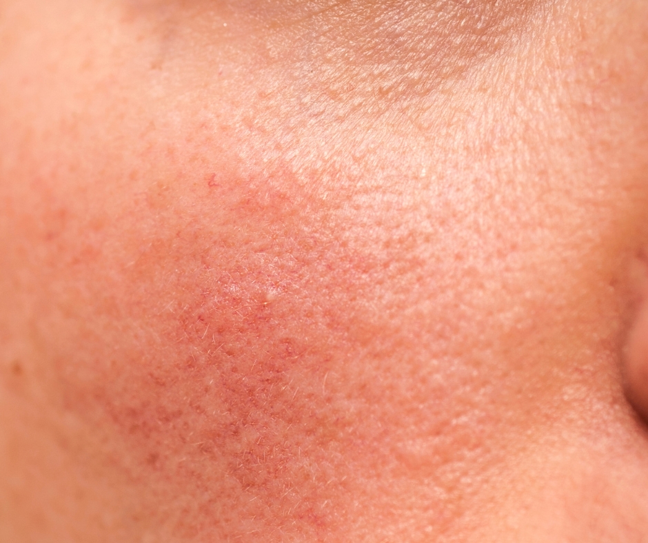 Hautunreinheiten – Detail