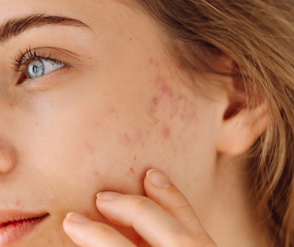 Blemished skin? Four steps to clear skin